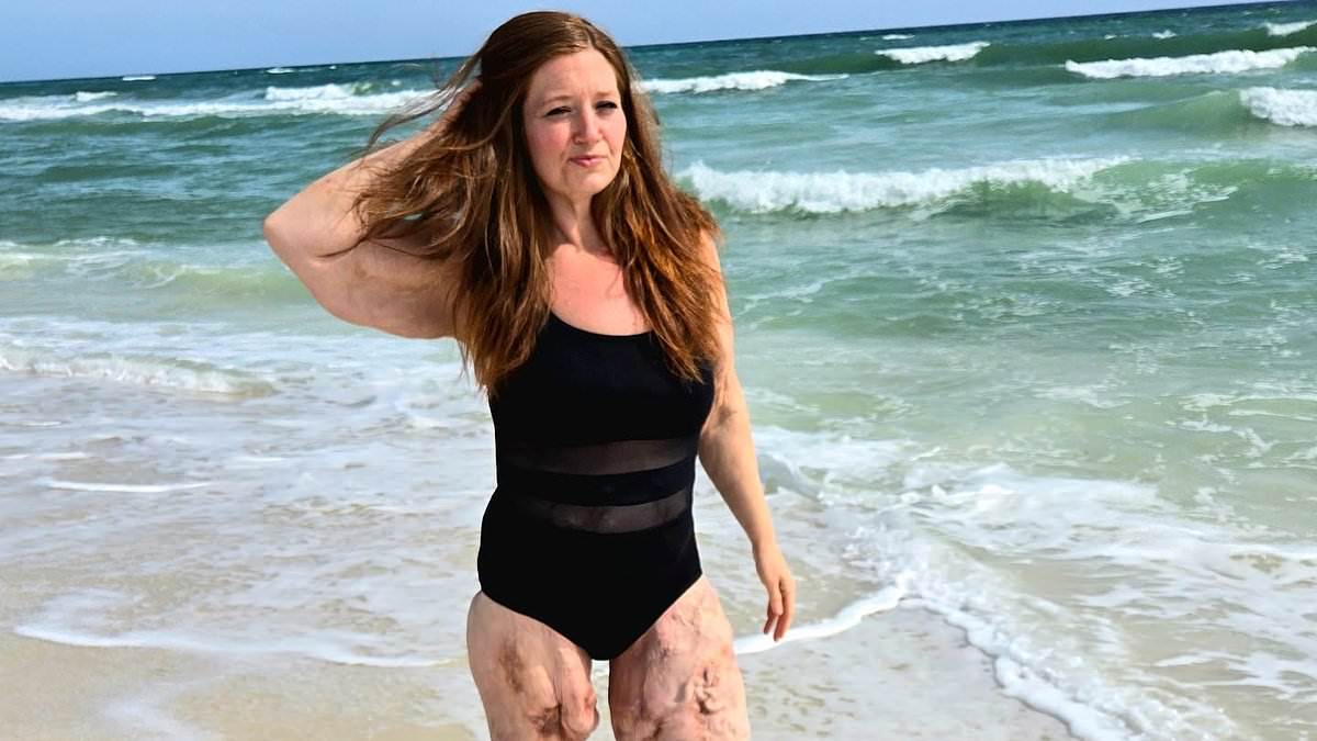 Experts say rapid weight loss from Mounjaro and other jabs can raise risk of loose skin — but it is not inevitable