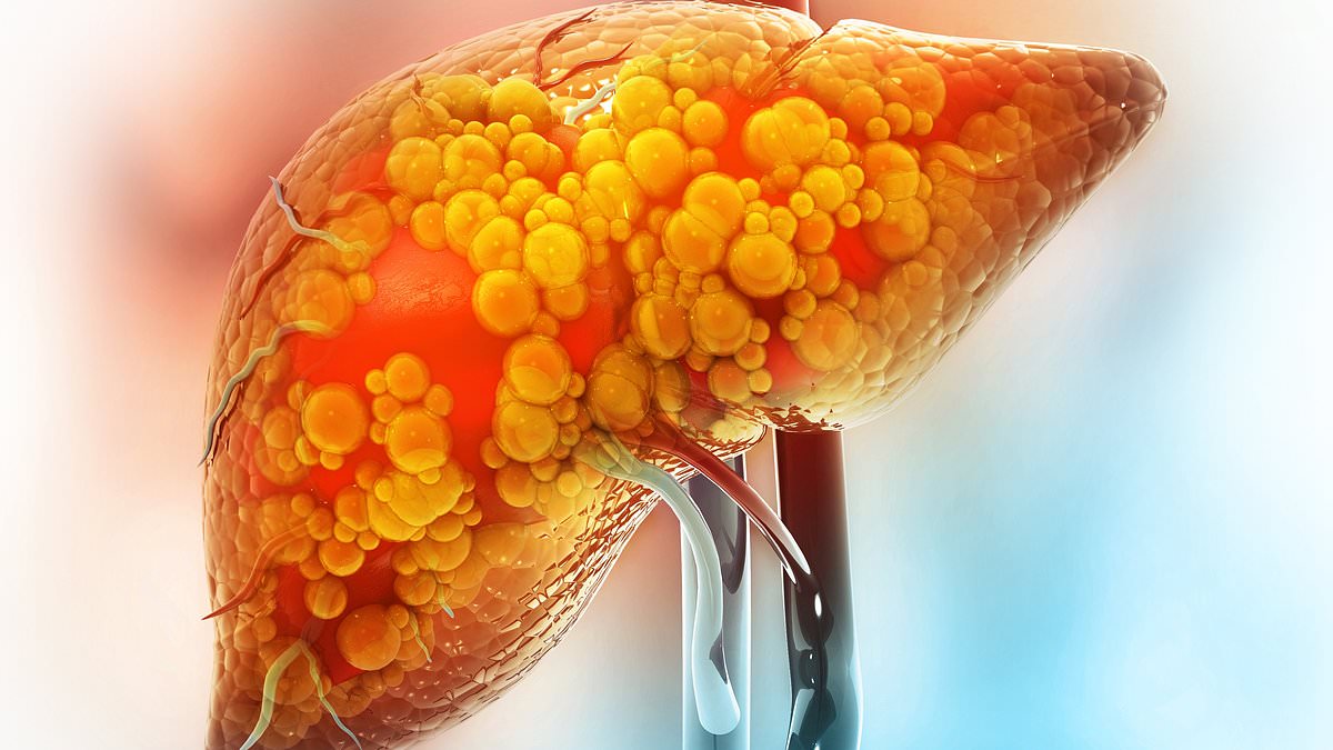Gut bacterial molecule drives liver sugar and fat production; biodegradable ‘trap’ reduces damage in mice