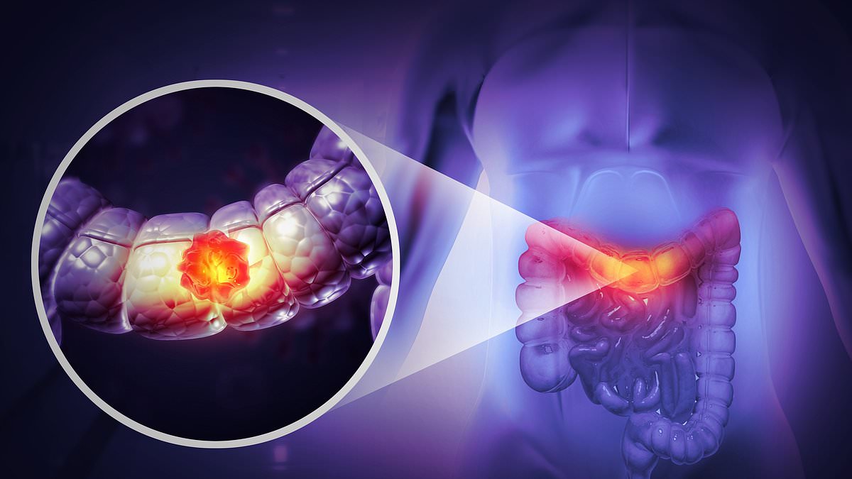 Expert warns five pain-free signs of bowel cancer as cases rise in younger adults