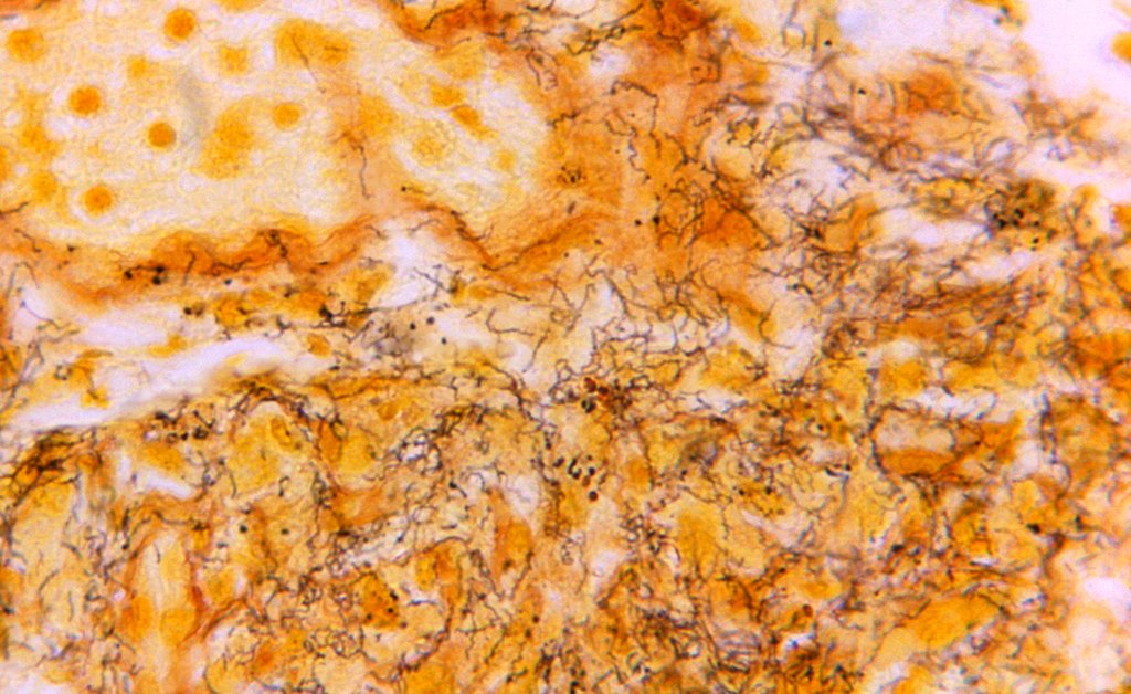 Congenital syphilis rises for 12th straight year as U.S. STIs overall decline