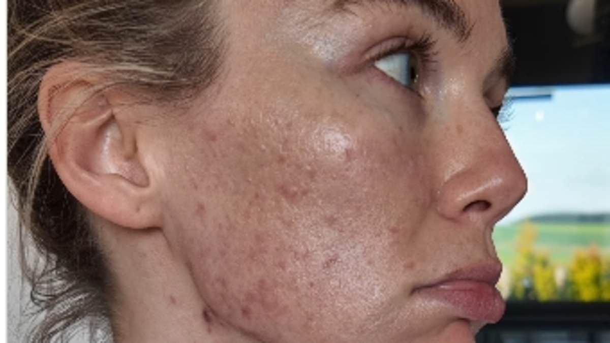 Georgia Toffolo opens up about relentless acne battle at age 30