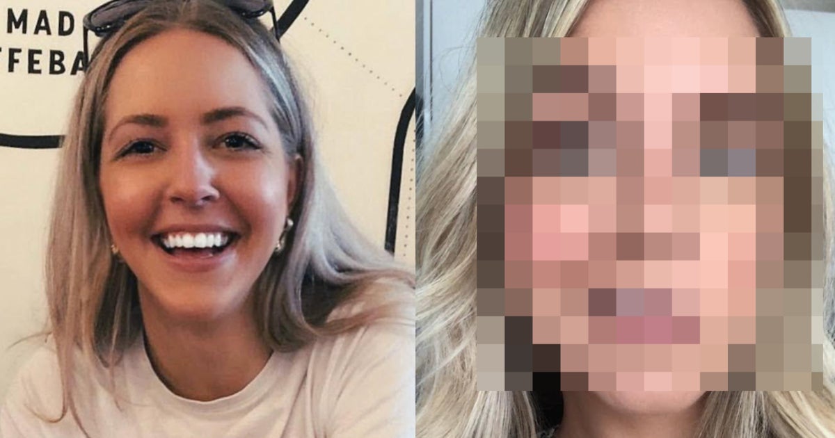 After Surgery Left Her Face Paralyzed, U.K. Patient Underwent Pioneering ‘Smile Surgery’ and Rebuilt Her Life