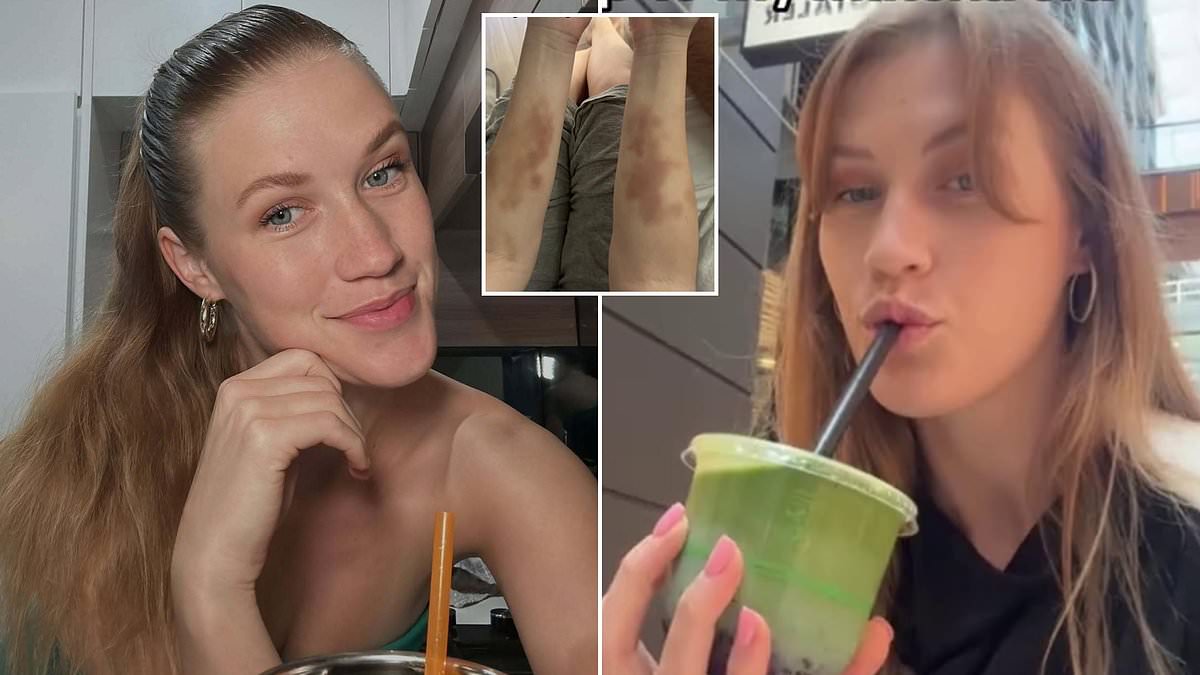 Daily matcha drink linked to severe iron deficiency and hospitalisation in young Australian woman