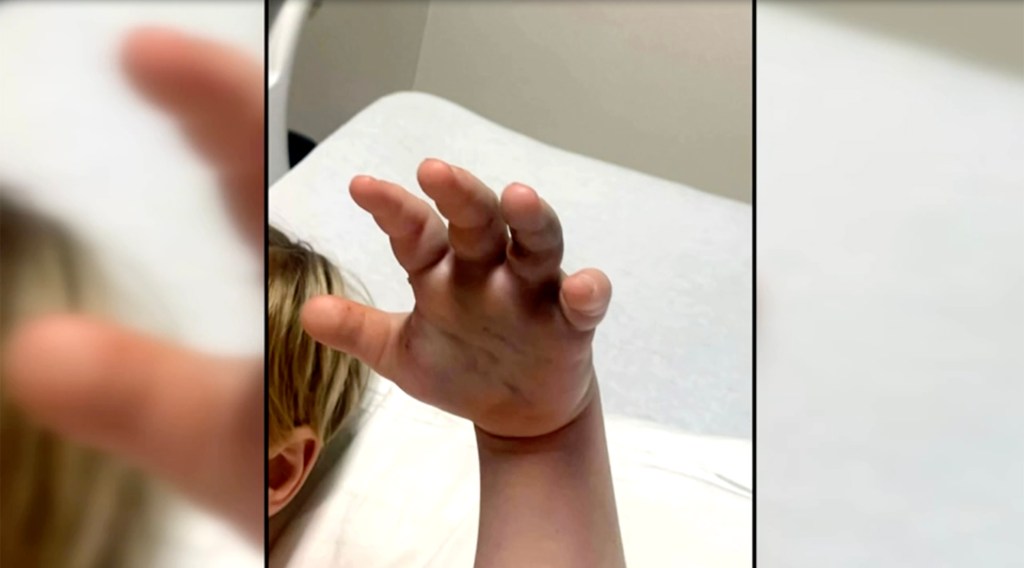 4-year-old bitten by copperhead at North Carolina day care; family says staff never called 911