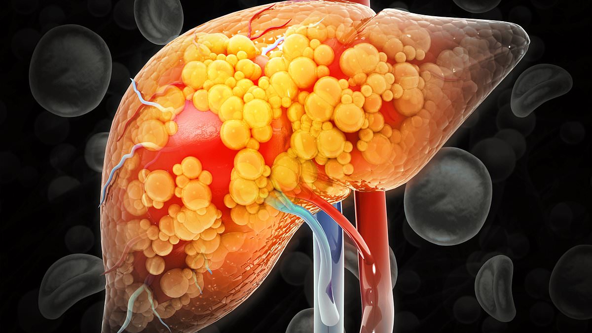 Three cardiometabolic risk factors linked to higher mortality in MASLD liver disease, study finds