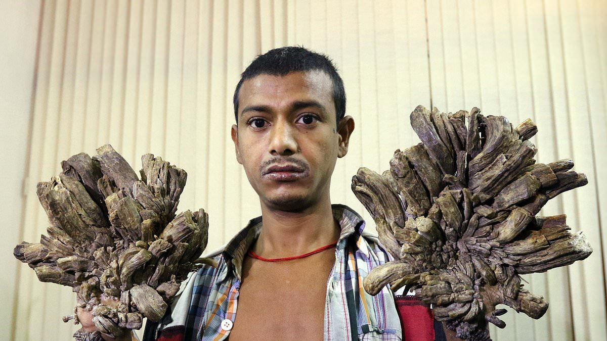 Tree Man Syndrome: Rare skin disorder leaves sufferers with bark-like growths