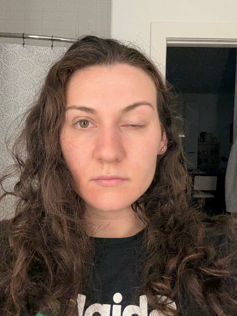 Botox for Migraines Leaves Woman with Near-Closed Eye, Prompting Scrutiny of Post-Treatment Care