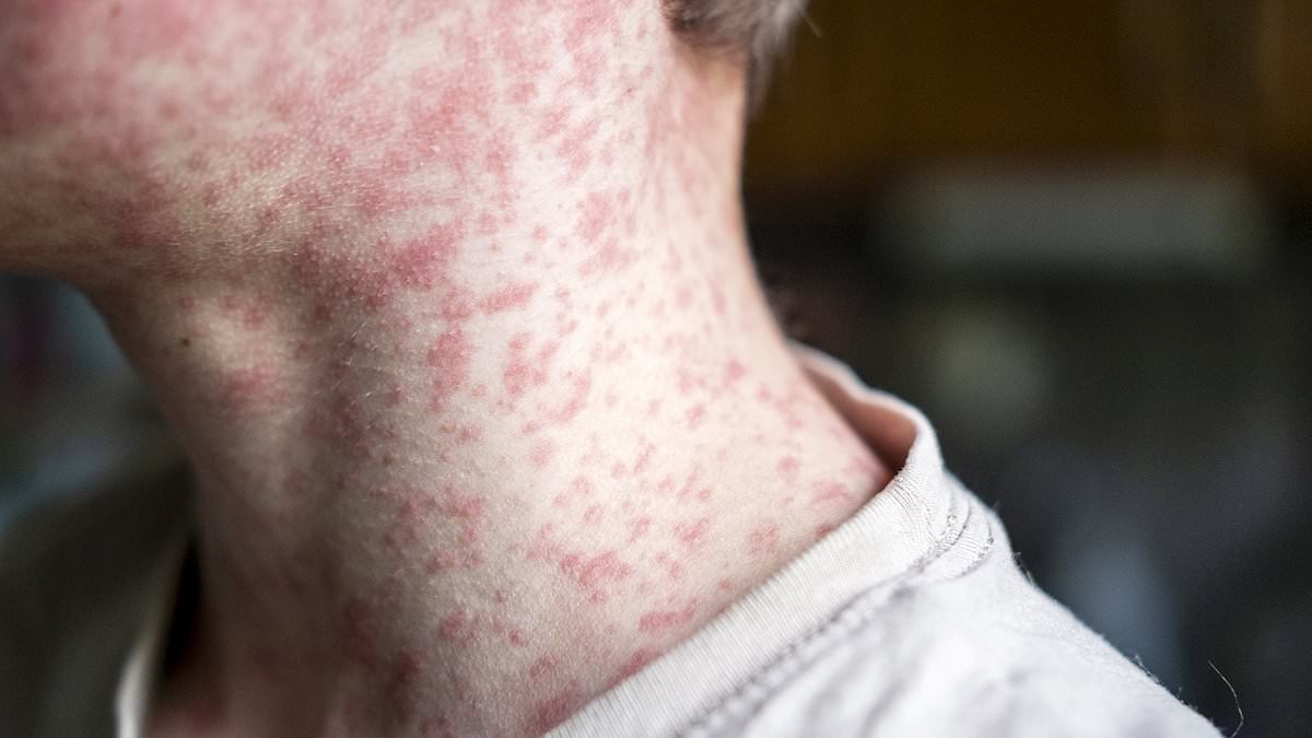 Mass exposure at Utah cycling meet linked to new measles cases as U.S. outbreak grows