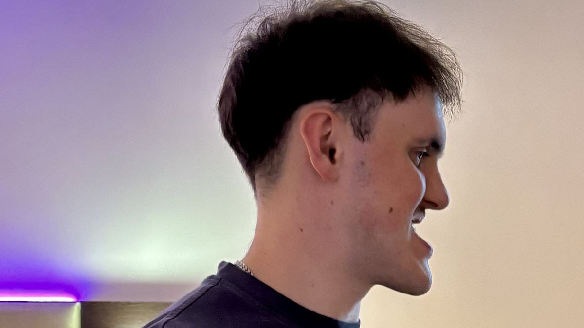 Man, 24, undergoes dramatic jaw surgery after a decade of taunts