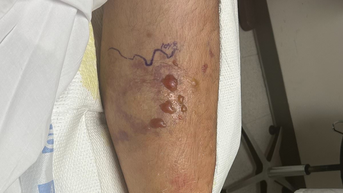 Louisiana reports fifth death from flesh-eating Vibrio vulnificus as infections rise along Gulf Coast