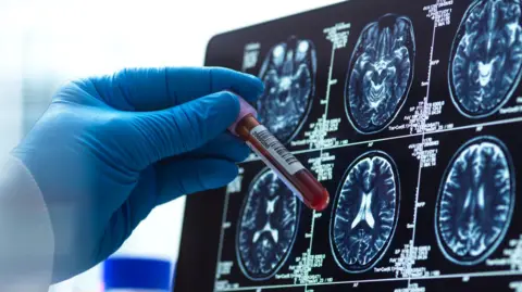 UK trial offers blood test to improve Alzheimer's diagnosis