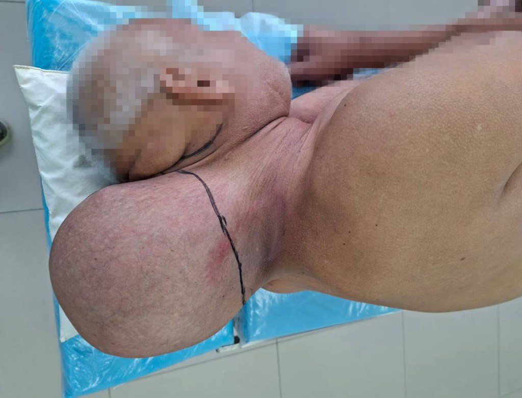 65-year-old Russian man has giant head-sized lipoma removed from neck after 16 years of home remedies