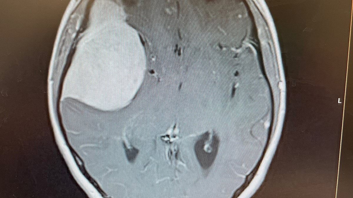 26-year-old woman diagnosed with brain tumour after GP dismissed headaches as pill side effects