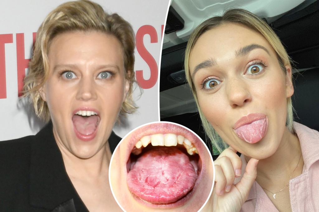 Kate McKinnon says she has ‘geographic tongue’; experts explain the benign condition