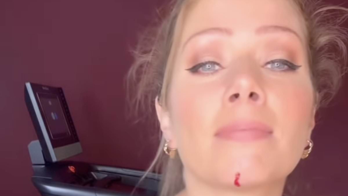 Nikki Sanderson rushed to hospital after treadmill accident leaves chin glued and skin injuries