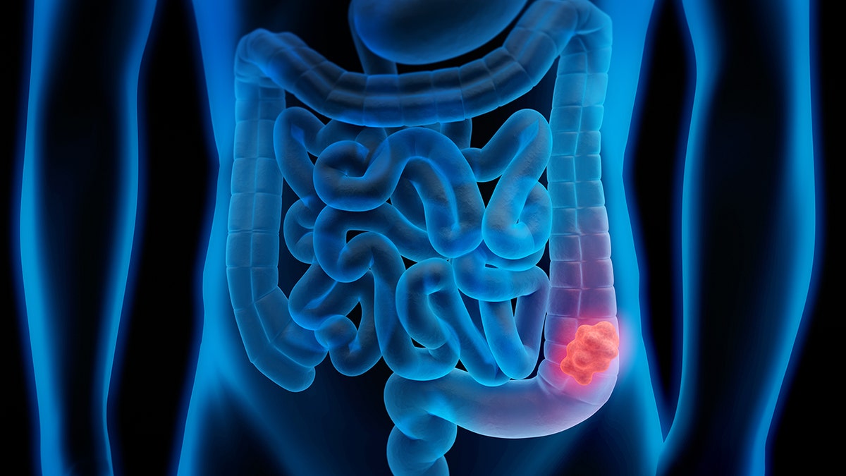 colon cancer illustration