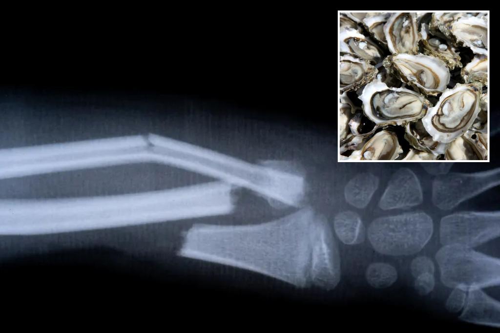 China-developed bone glue claims to fix fractures in minutes