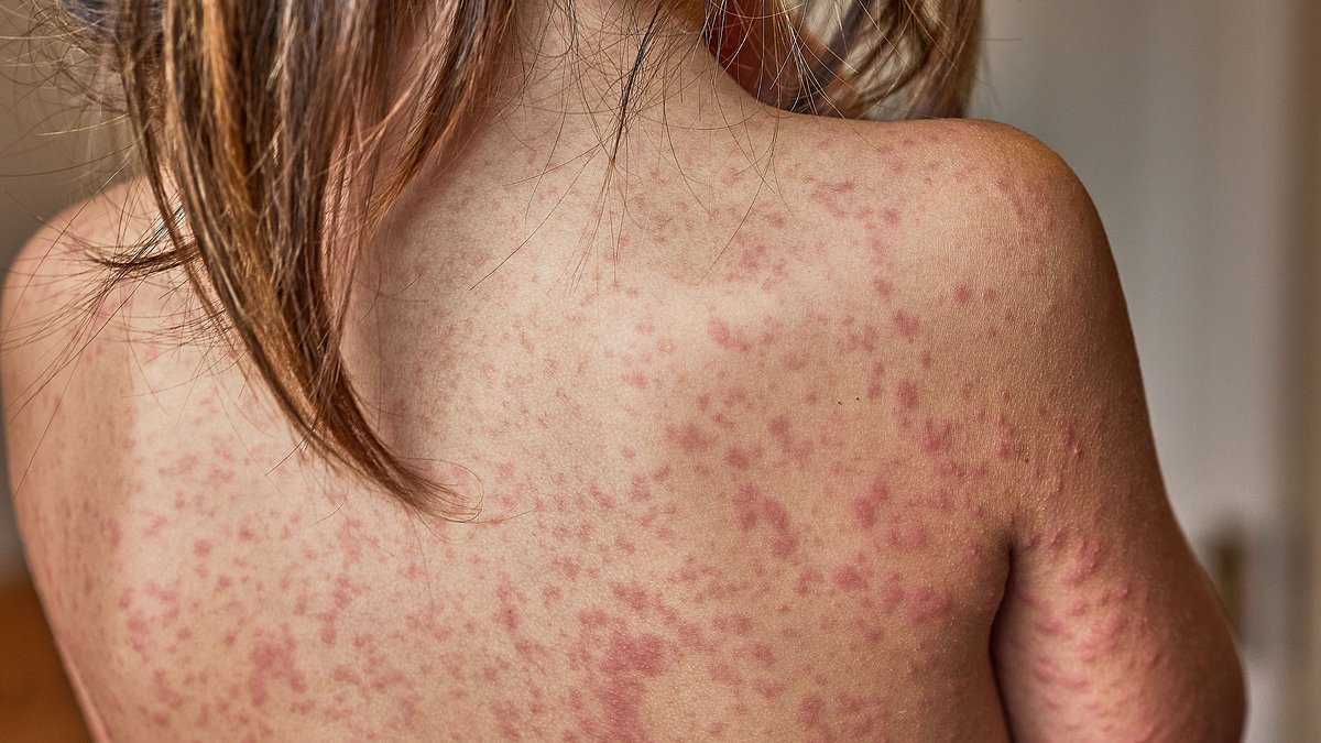 California child dies years after measles infection from rare brain complication