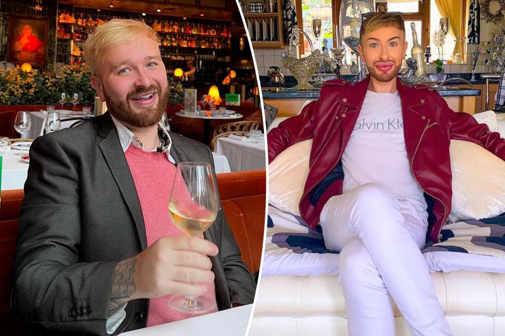 British man spent £3,500 on filler addiction; now warns of the risks