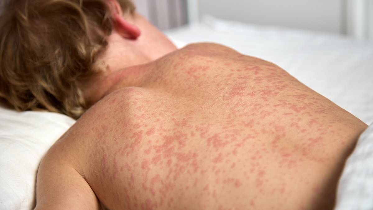 Utah measles exposure prompts rapid post-exposure treatment for 11 infants