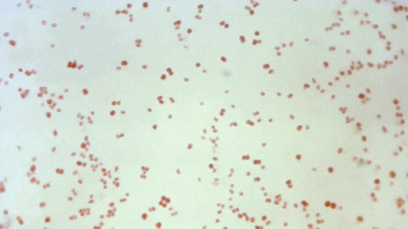 STD rates dip in 2024, but congenital syphilis in newborns rises, CDC data show