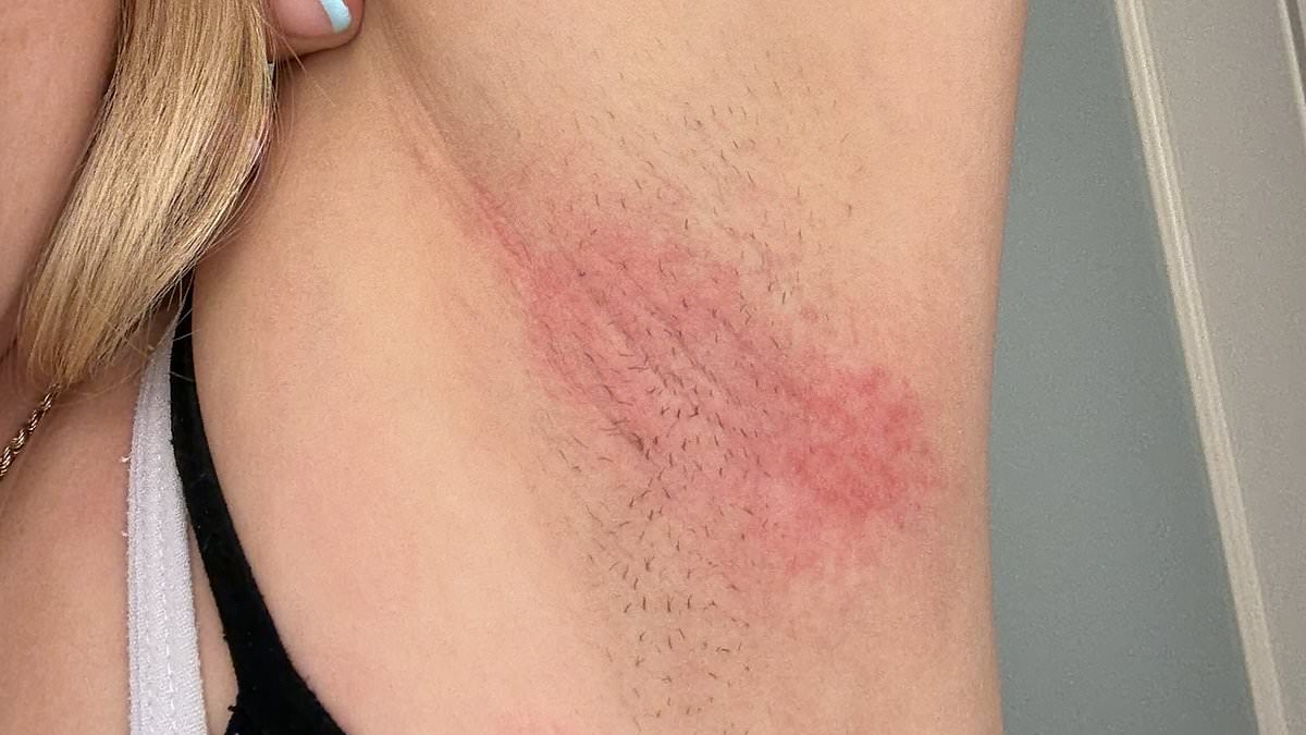 Mitchum deodorant linked to painful armpit burns and rashes, company says manufacturing change to blame