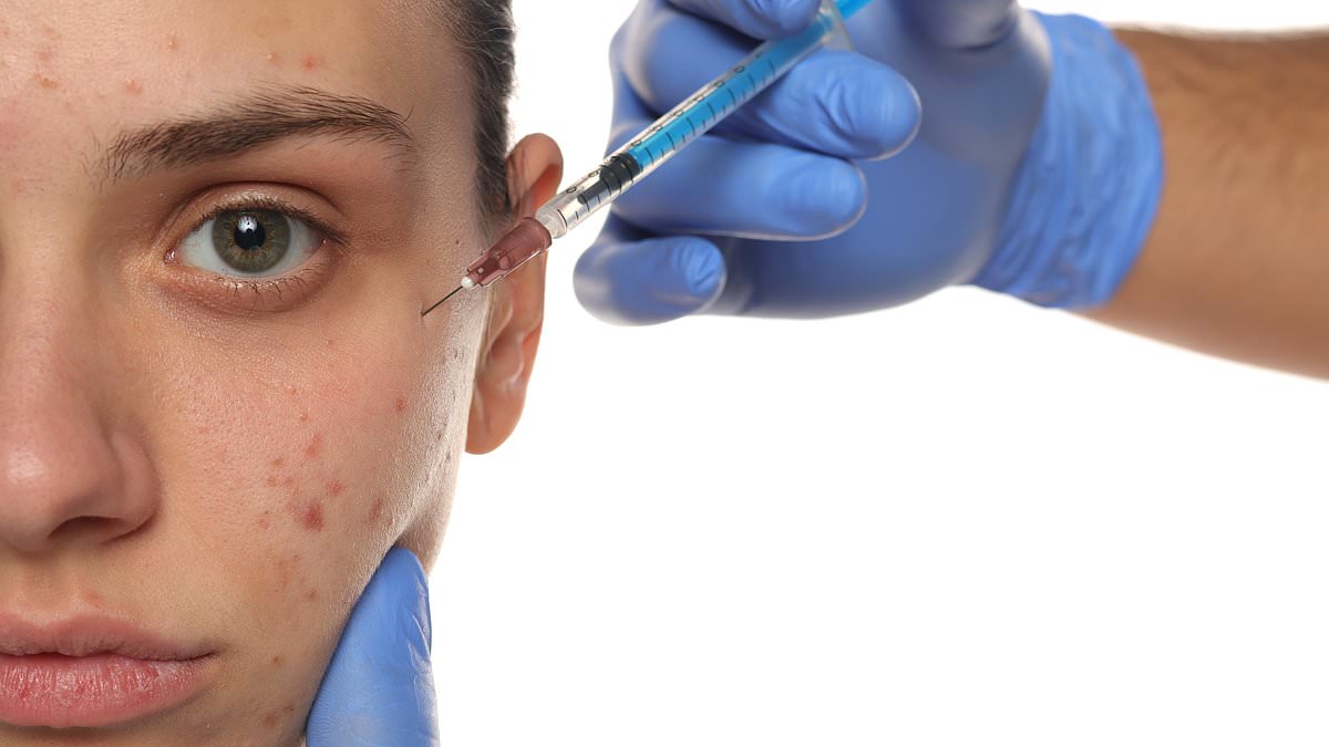 New acne vaccines aim to permanently curb acne, including prevention for those with family history