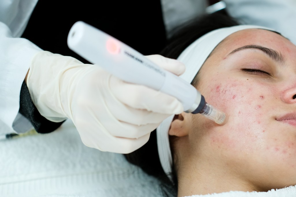 Experts warn at-home microneedling devices can scar you for life