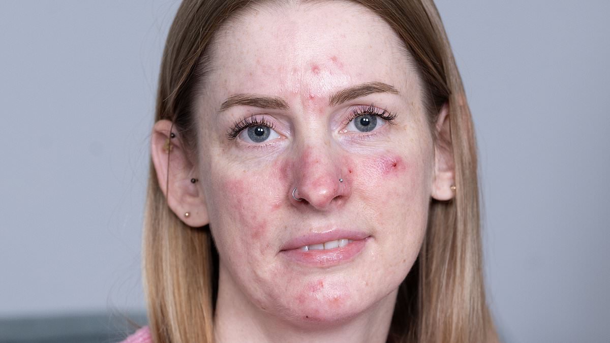 Rosacea patient finds relief after years of suffering